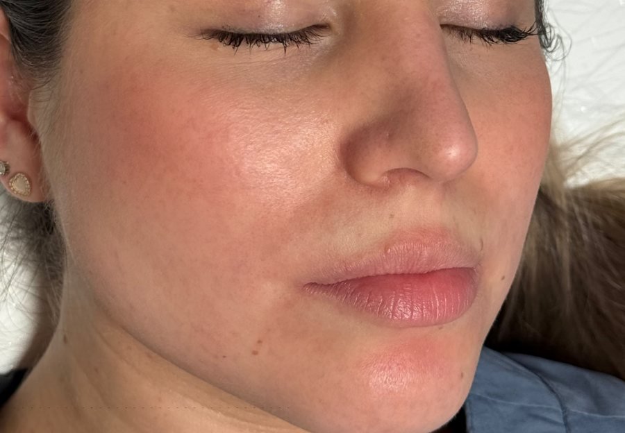Antes labios