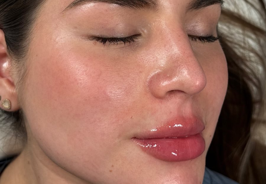 Después labios