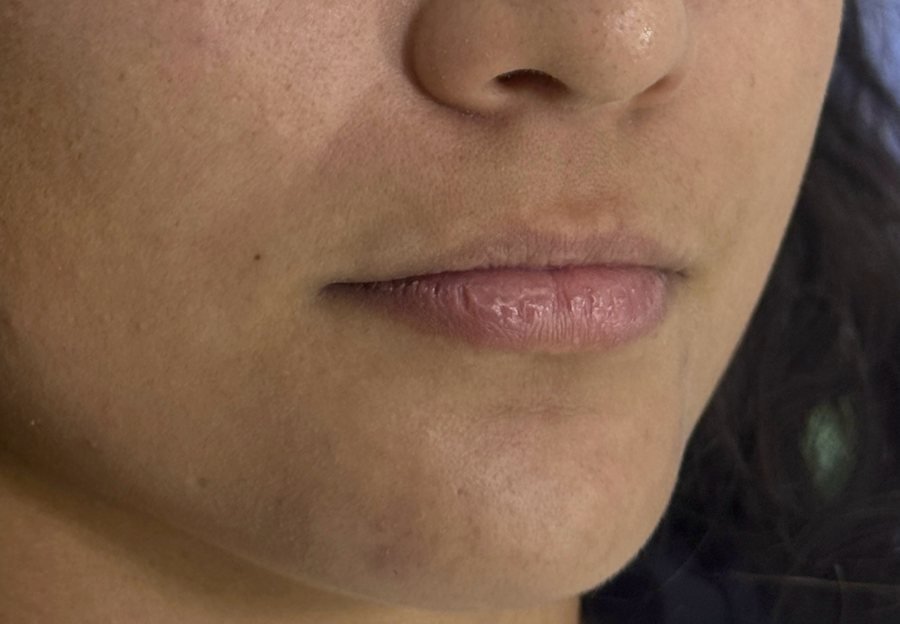 Antes labios