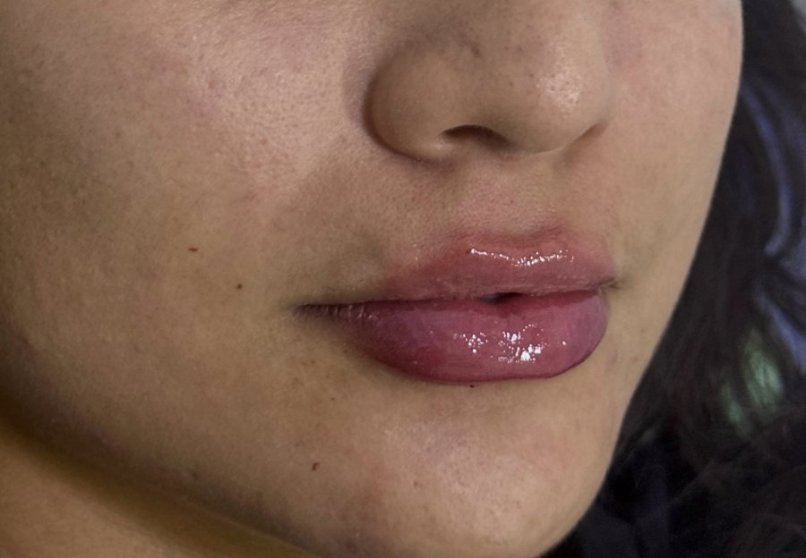 Después labios