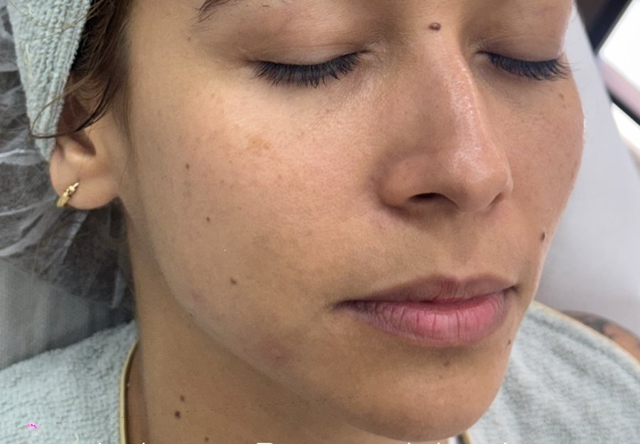 Antes labios+rinomod