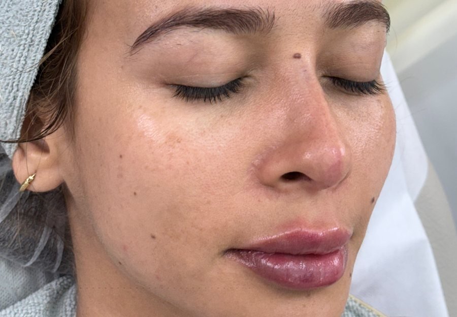 Después labios+rinomod