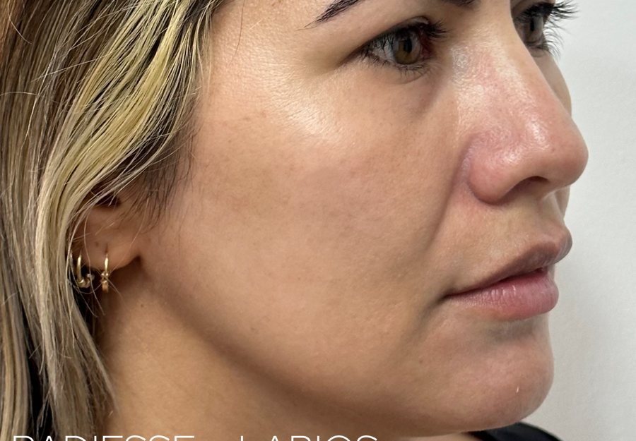 Antes Radiesse+labios