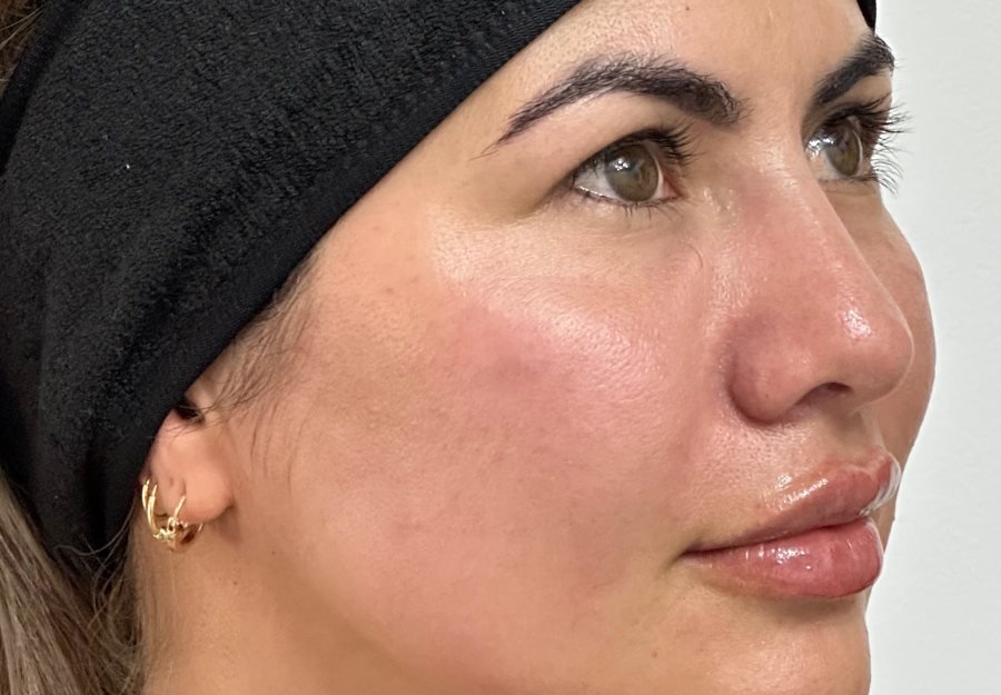 Después Radiesse+labios