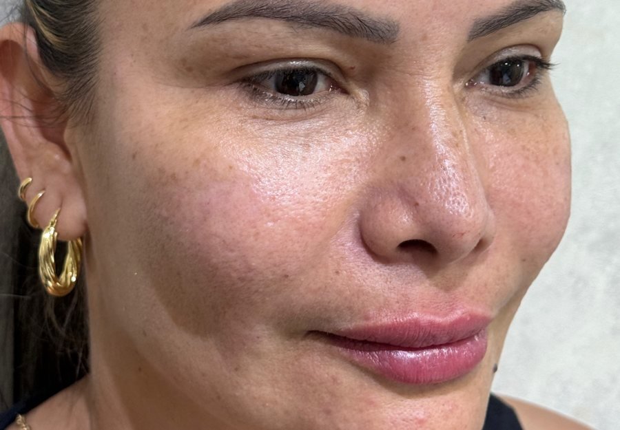 Después Sculptra