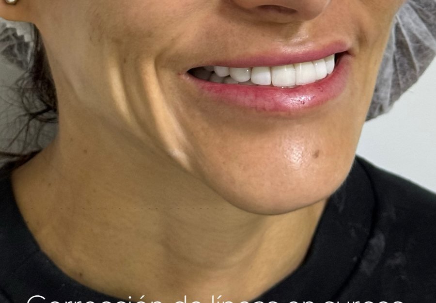 Antes Botox sonrisa
