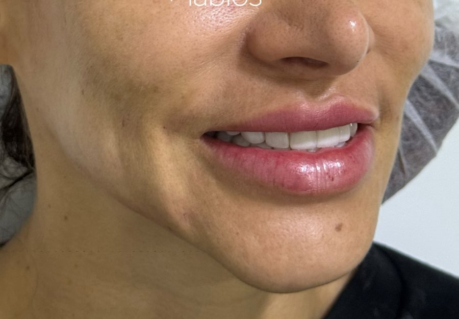 Después Botox sonrisa