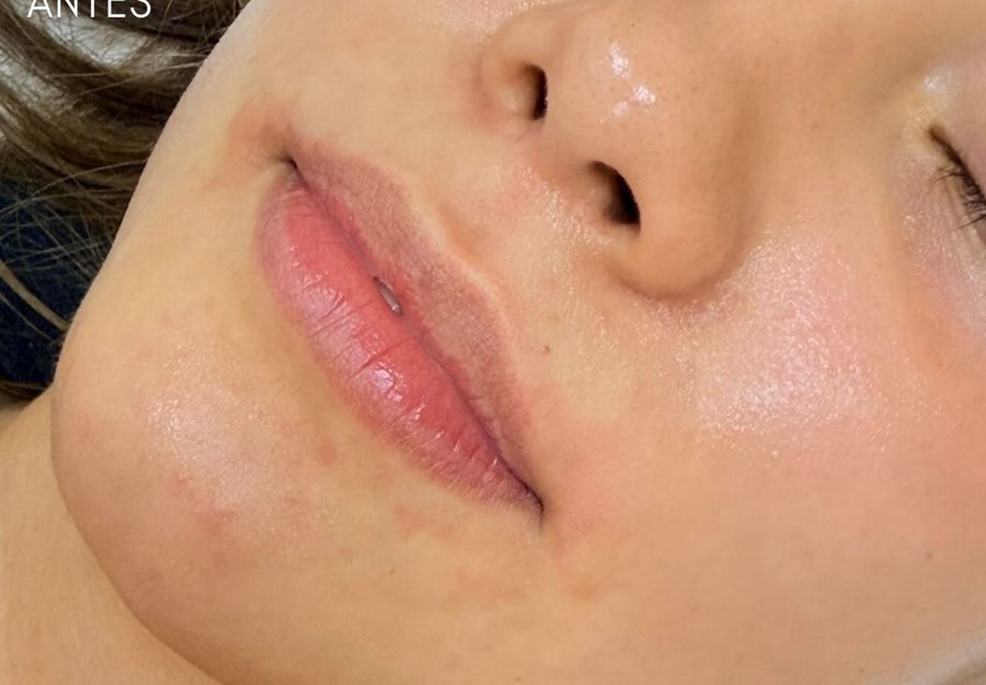 Antes labios