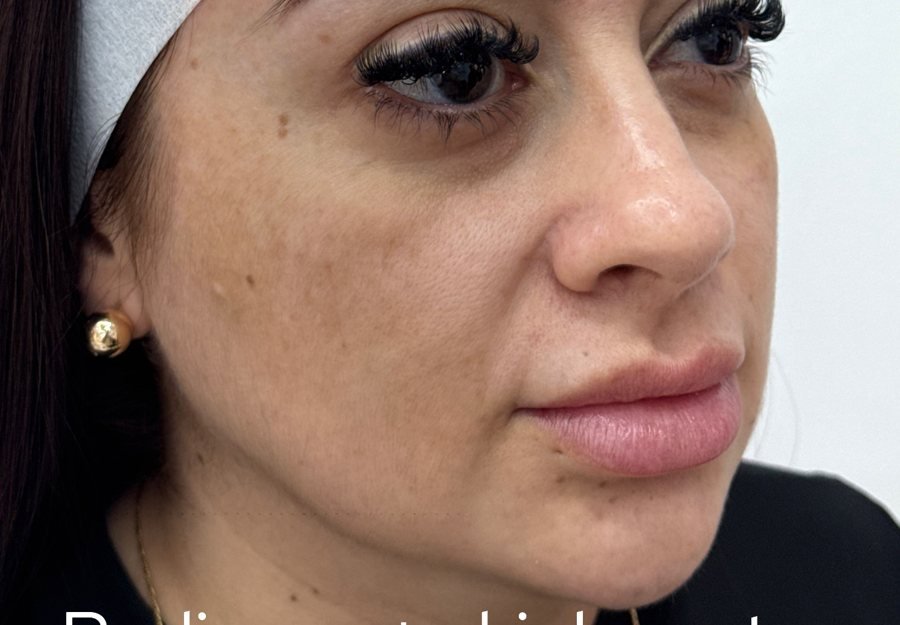 Antes Radiesse + Skinbooster