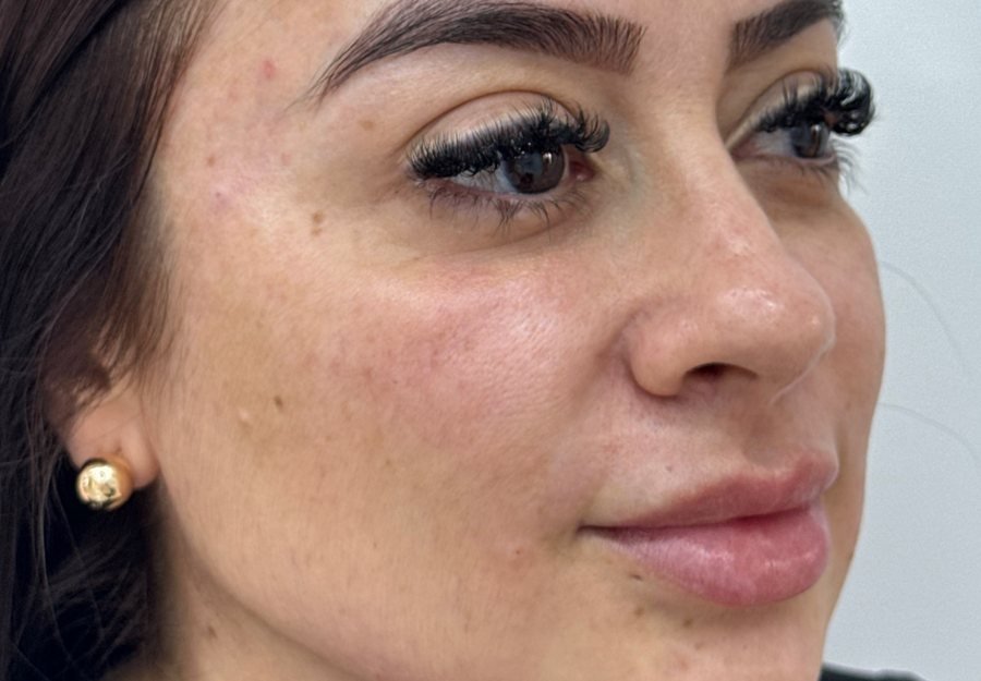 Después Radiesse + Skinbooster